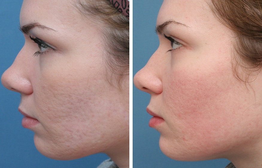 Types of Acne Scars That Are Fixable With Laser Treatment